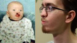 David Bufkin, who was born with a cleft palate, underwent life-changing facial surgery at age 20.